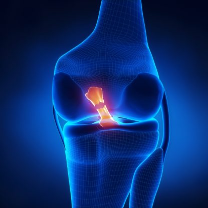 Frequently Asked Questions About ACL Reconstruction Surgery - Blog Post